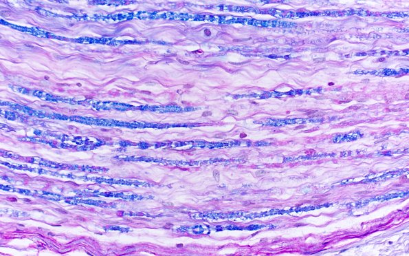 4B3 CIDP (Case 4) D Anterior Interosseus nerve LFB-PAS 40X