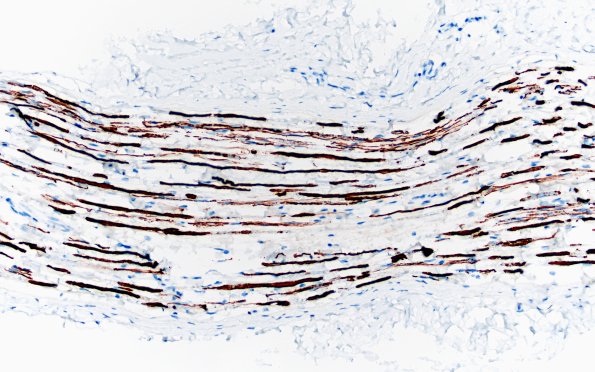 4C2 CIDP (Case 4) D Anterior Interosseus nerve NF 20X