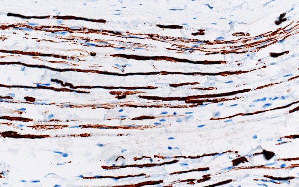 4C3 CIDP (Case 4) D Anterior Interosseus nerve NF 40X