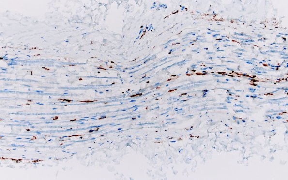 4D CIDP (Case 4) D Anterior Interosseus nerve CD163 20X