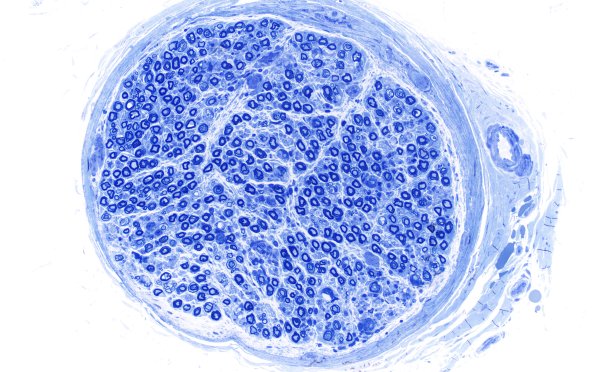 4E1 CIDP (Case 4) D Anterior Interosseus nerve Plastic 10X 2