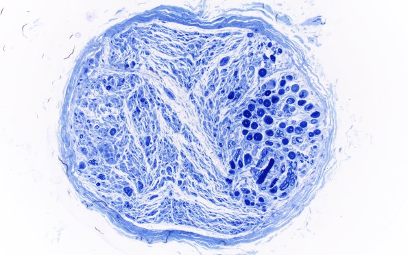 4E2 CIDP (Case 4) D Anterior Interosseus nerve Plastic 20X