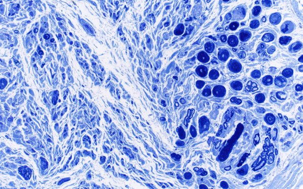 4E3 CIDP (Case 4) D Anterior Interosseus nerve Plastic 40X