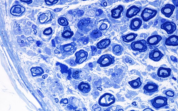 4E4 CIDP (Case 4) D Anterior Interosseus nerve Plastic 100X 10