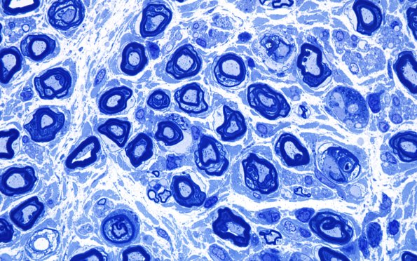 4E5 CIDP (Case 4) D Anterior Interosseus nerve Plastic 100X 11