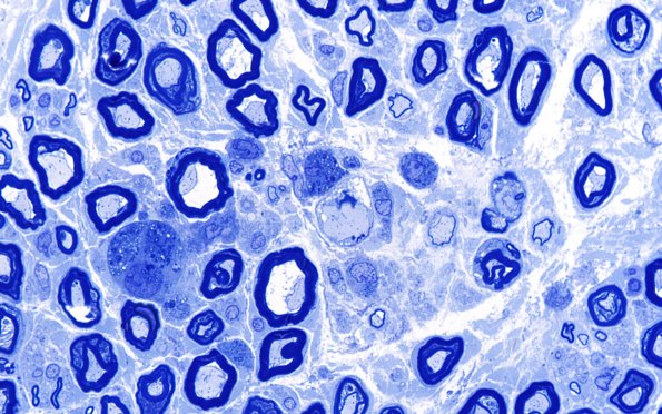 4E6 CIDP (Case 4) Part C Flex Dig Long Plastic 100X 3