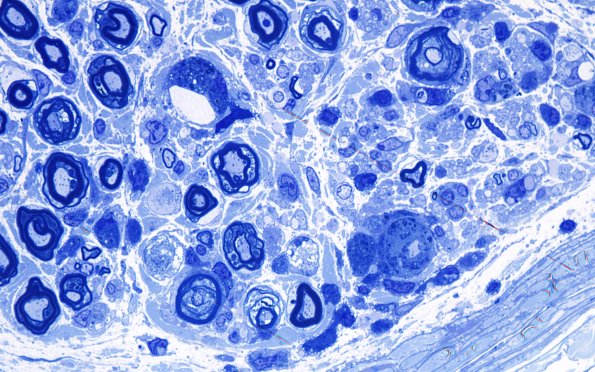 4E7 CIDP (Case 4) D Anterior Interosseus nerve Plastic 100X 12