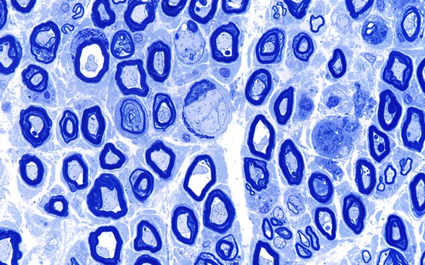 4E8 CIDP (Case 4) Part C Flex Dig Long Plastic 100X 1