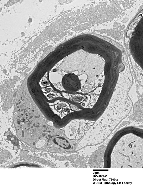 4F1 Case 4 Ant Interosseus nerve_031.jpg