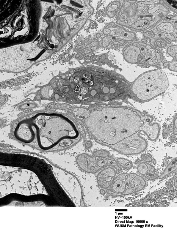 4F10A (Case 4) Ant Interosseus nerve_052 - Copy