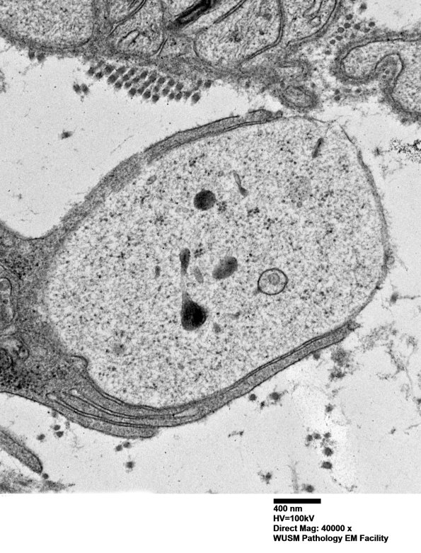 4F10B (Case 4) Ant Interosseus nerve_050 - Copy