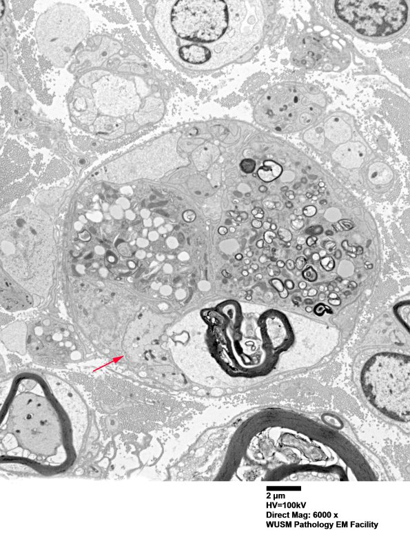 4F2 Case 4 Ant Interosseus nerve_025 copy.jpg