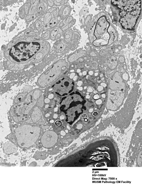 4F3 Case 4 Ant Interosseus nerve_048.jpg