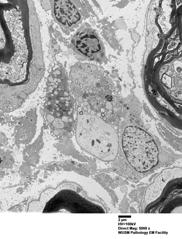 4F4A Case 4 Ant Interosseus nerve_018.jpg