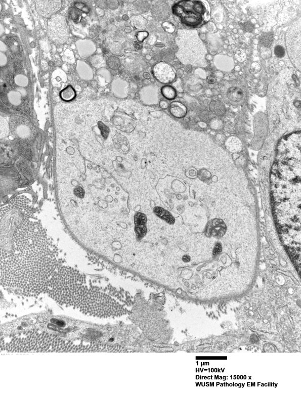 4F4B (Case 4) Ant Interosseus nerve_020 - Copy