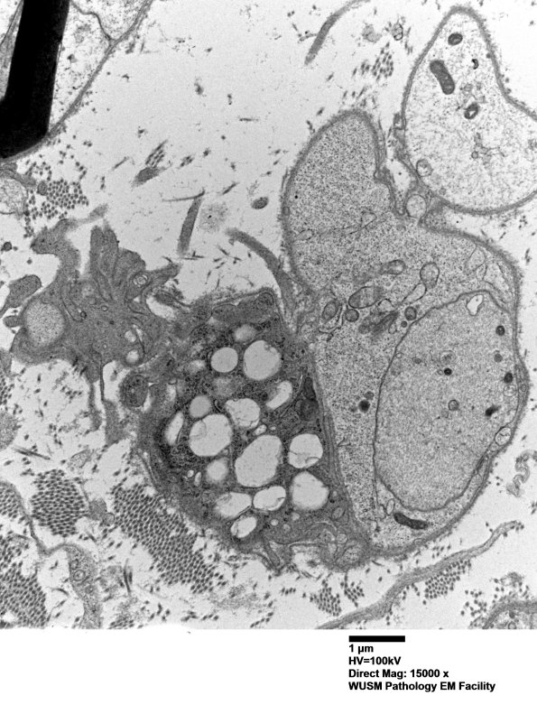 4F5A Case 4 Ant Interosseus nerve_033.jpg