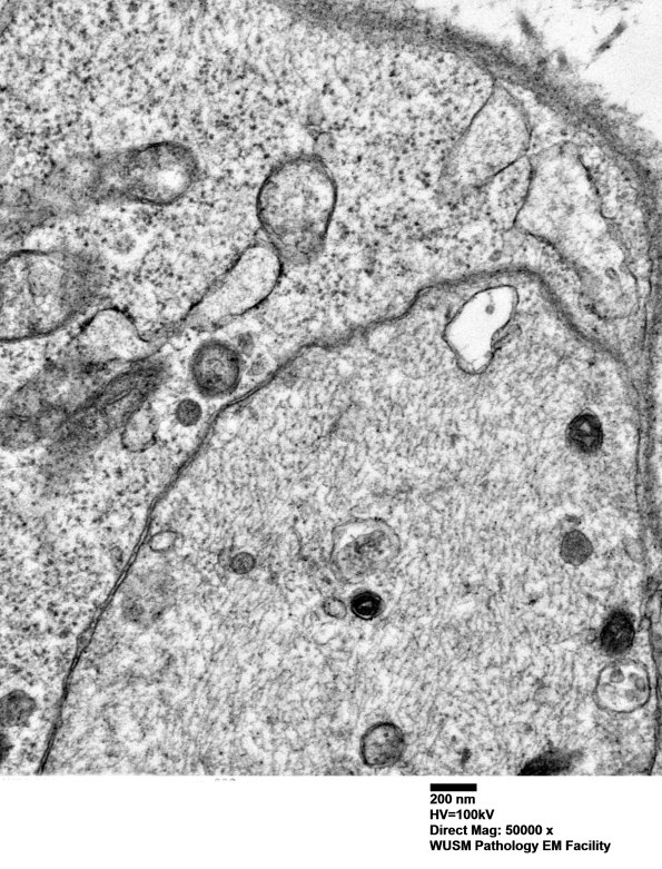 4F5B (Case 4) Ant Interosseus nerve_036 - Copy
