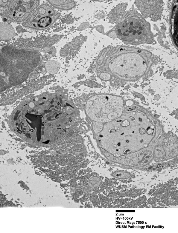 4F6 Case 4 Ant Interosseus nerve_058.jpg