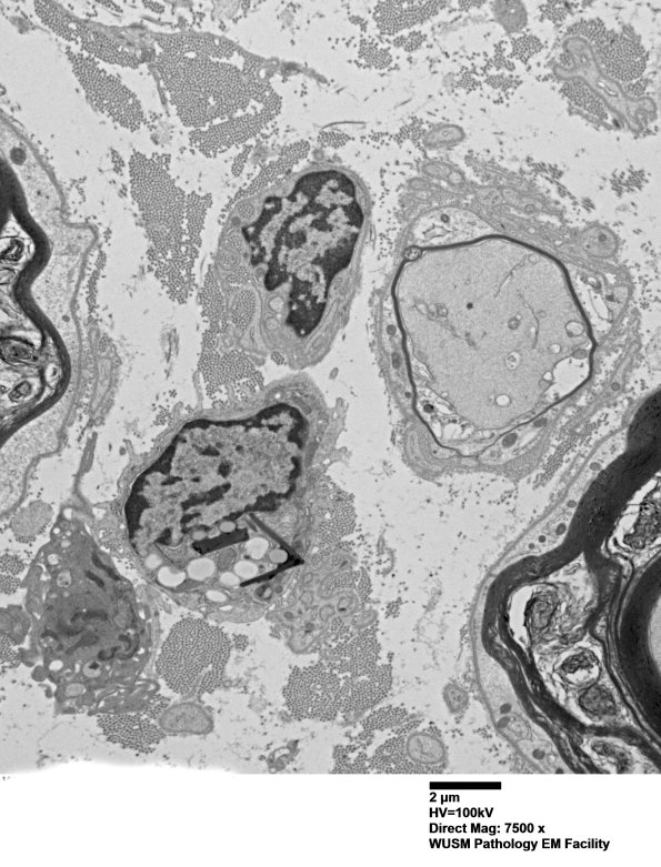 4F8 Case 4 Ant Interosseus nerve_056.jpg