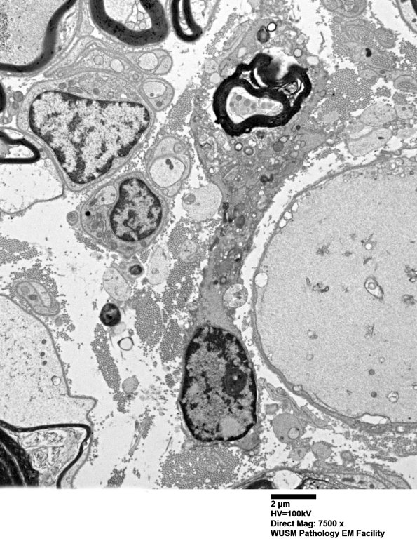 4F9A (Case 4) Ant Interosseus nerve_028 - Copy