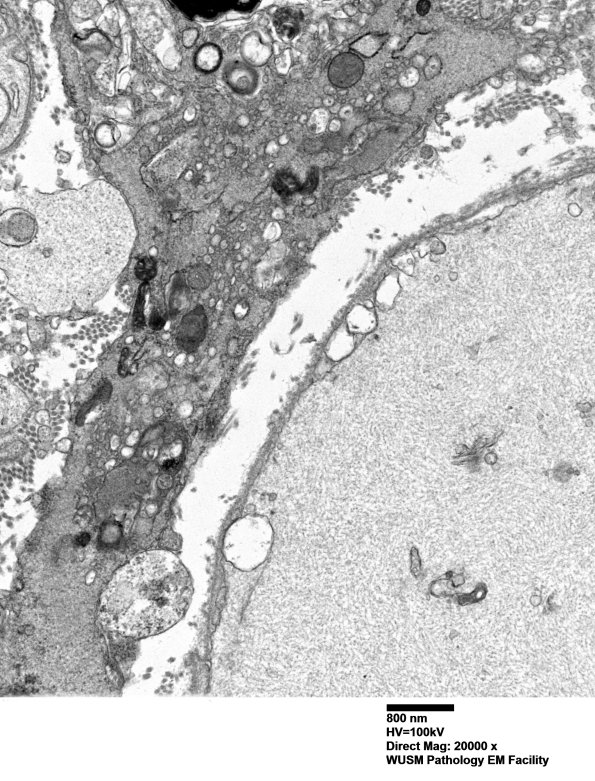4F9B (Case 4) Ant Interosseus nerve_030 - Copy