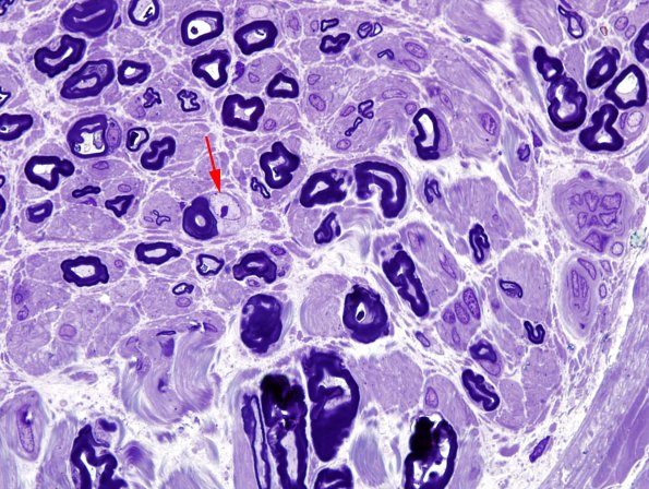 5A Activated Schwann Cell (Case 5) Plastic copy.jpg