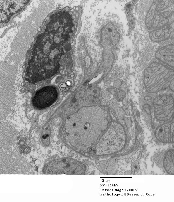 5B7 CIDP (Case 5) EM 012 - Copy