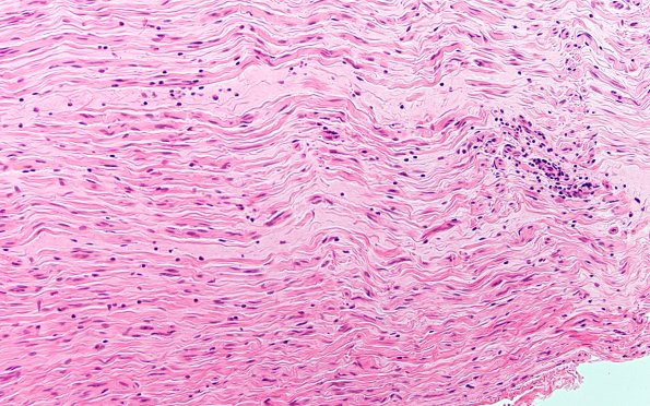 6A1 Case 6 H&E 20X 2