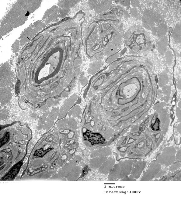 6C1 CIDP (Case 6) Wepler_001 - Copy
