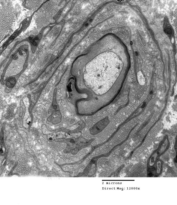 6C2 CIDP (Case 6) Wepler_003 - Copy