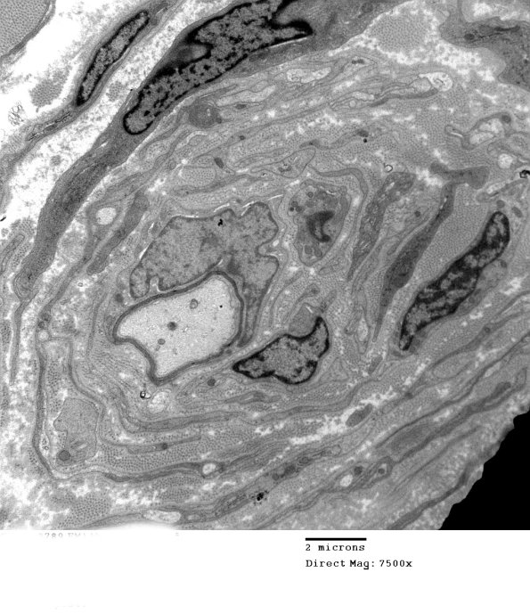 6C3 CIDP (Case 6) Wepler_005 - Copy