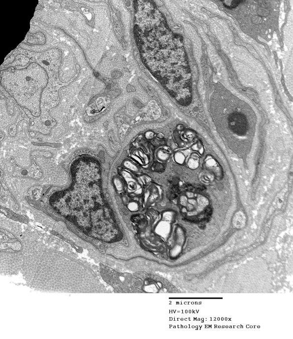 6C4 CIDP Case 6_032 - Copy