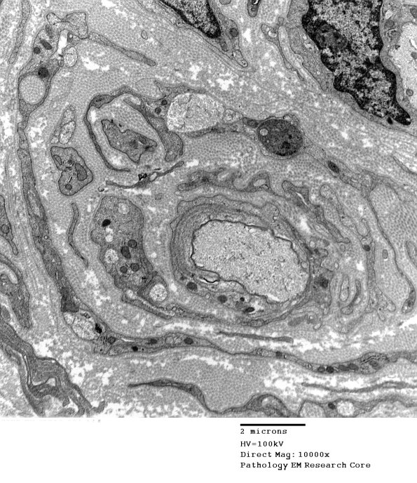 6C5 CIDP Case 6_030 - Copy