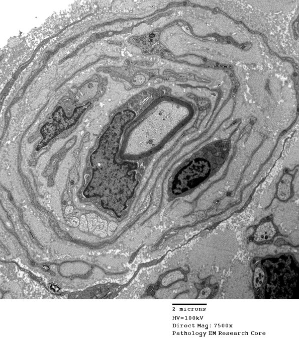 6C7 CIDP Case 6_006A - Copy
