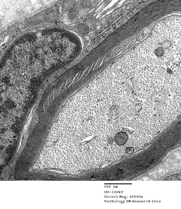 6C8 CIDP Case 6_008A - Copy