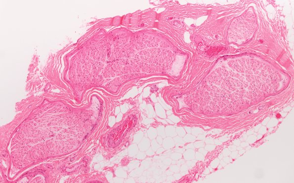 7A1 CIDP (Case 7) H&E 10X