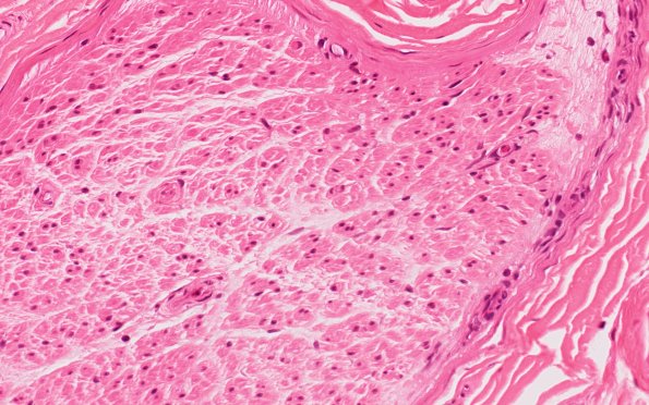 7A2 CIDP (Case 7) H&E 40X