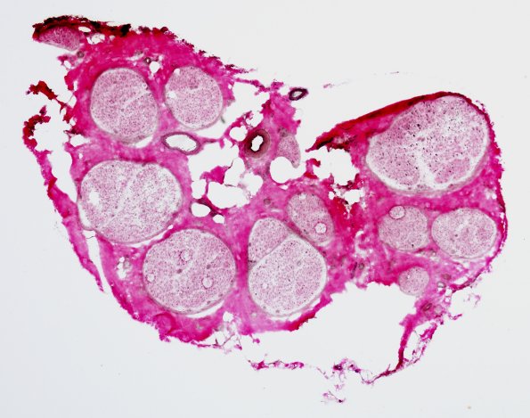7A1 CIDP (Case 7) VVG 3