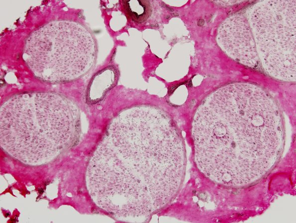 7B2 CIDP (Case 7) VVG 2