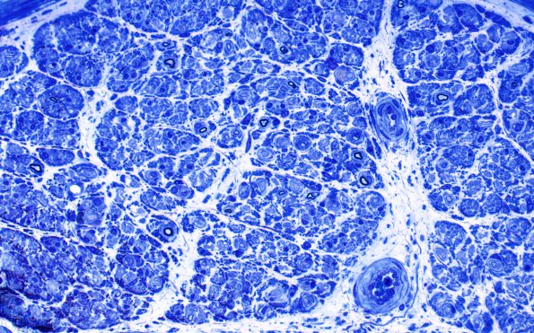 7D2 CIDP (Case 7) Plastic 40X 2a