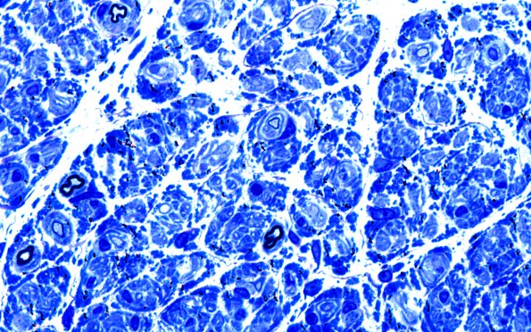 7D3 CIDP (Case 7) Plastic 100X 2