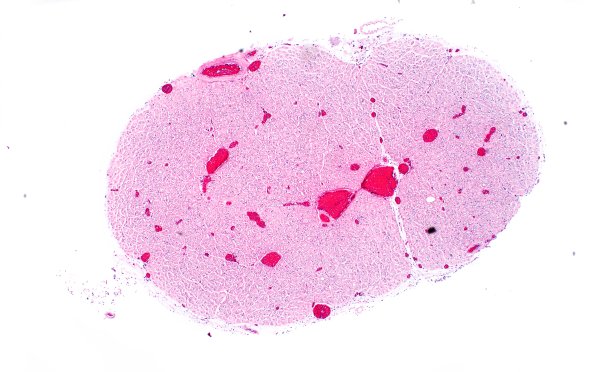 8B2 CIDP (Case 8) Roots H&E 4X 1