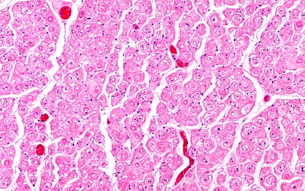 8B3 CIDP (Case 8) Roots H&E 20X 1