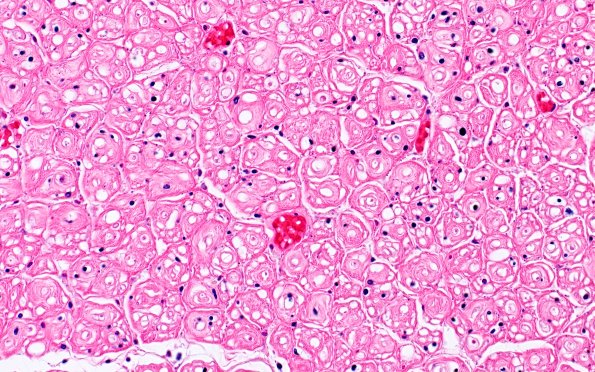 8B4 CIDP (Case 8) Roots H&E 40X 2
