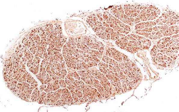 8C2 CIDP (Case 8) Roots S100 10X (smaller root)