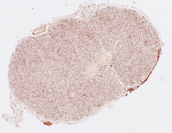 8C3 CIDP (Case 8) Roots S100 4X
