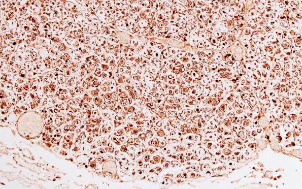 8C4 CIDP (Case 8) Roots S100 20X