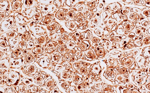 8C5 CIDP (Case 8) Roots S100 40X 2