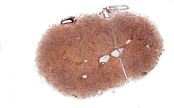 8D1 CIDP (Case 8) Roots Coll IV 4X
