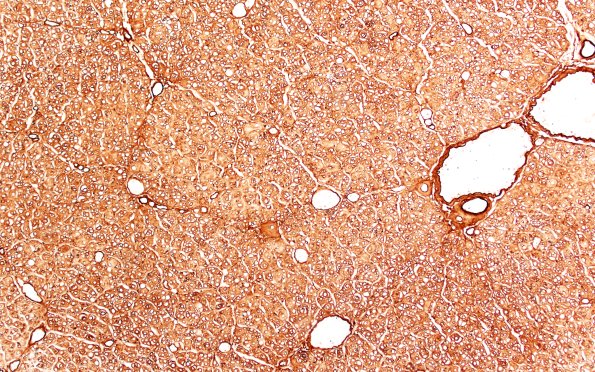 8D2 CIDP (Case 8) Roots Coll IV 10X